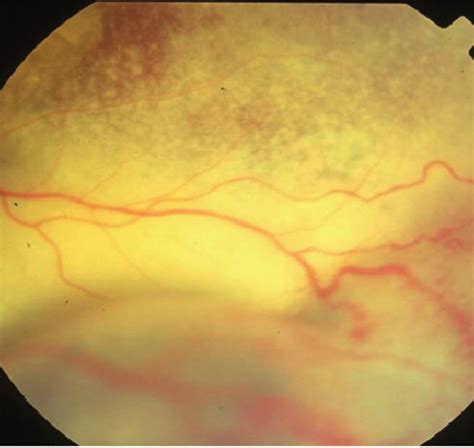 Coats Disease Presence Of Serous Retinal Detachment And Intense