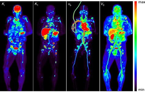 Total Body Pet Multiparametric Imaging Of Cancer Using A Voxelwise