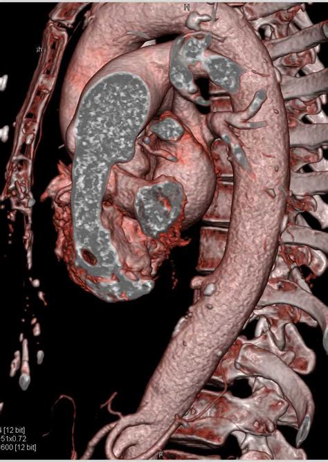 Penetrating Ulcer In The Descending Thoracic Aorta Vascular Case