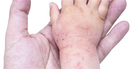Dermatitis Atópica Qué Es Causas Síntomas Y Tratamientos Cosas De