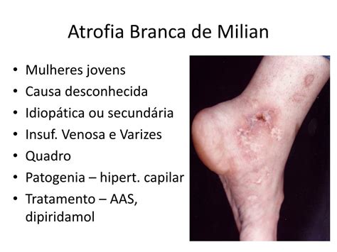 Atrofia Branca De Milian