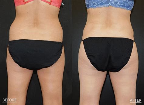 Omaha Cosmetic Surgery Tumescent Liposuction Schlessinger Md