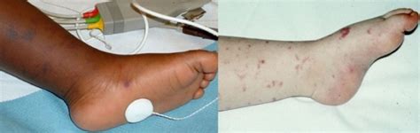 Fifteen Minute Consultation The Child With A Non Blanching Rash Adc