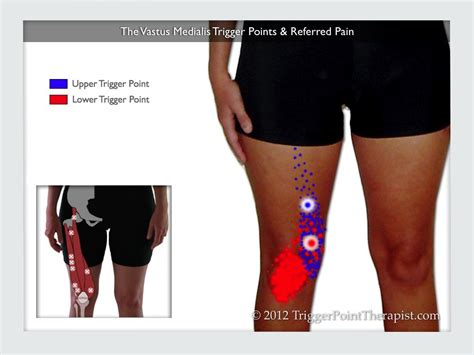 Vastus Medialis Trigger Points The Knee Pain Trigger Points Part 3