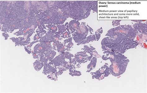 Ovary Serous Carcinoma Serous Cystadenocarcinoma Nus Pathweb
