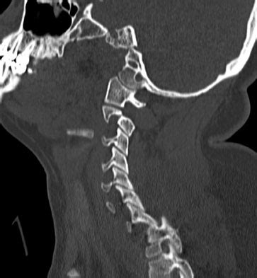 Cervical Facet Dislocations & Fractures - Spine - Orthobullets