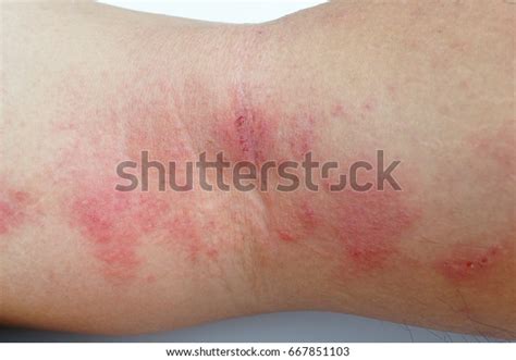 Allergic Rash Dermatitis Eczema Skin Patient Stock Photo Edit Now
