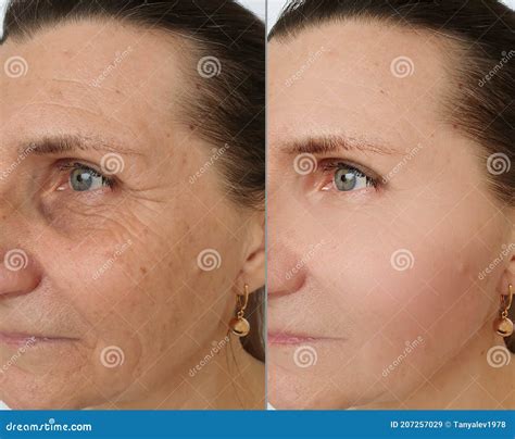 Woman Face Swollen Rejuvenation Wrinkles Before And After Tightening