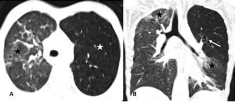 Unmasking Of Left Upper Lobe Bronchial Atresia In A Case Of H1n1