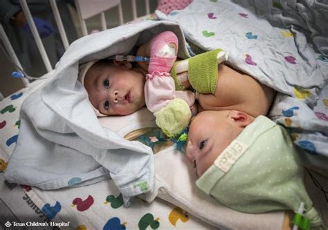 Texas Twins Conjoined At Birth Undergo Separation Surgery