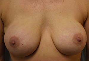 Fort Worth Nipple Sparing Mastectomies Reconstruction Before And After Photos Texas Plastic