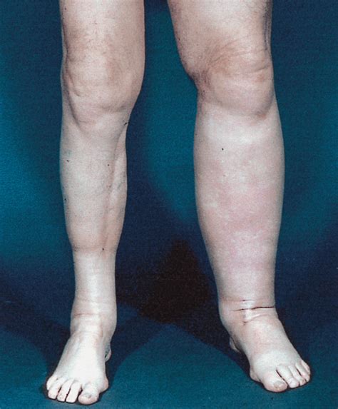 The Multiple Causes Of Swollen Legs