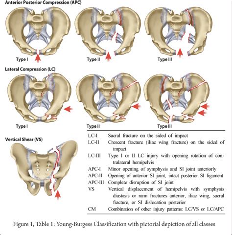 Classification Of Pelvis And Aetabulum Injuries Trauma International