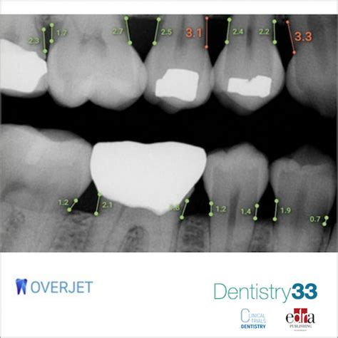 Overjet Wins FDA Nod For AI Software Dentistry33