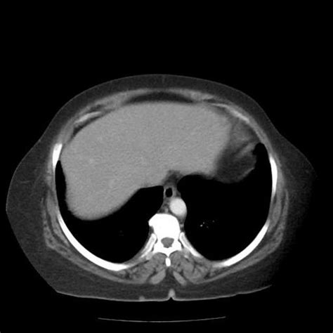 Abdominal Retroperitoneal Cystic Lymphangioma Radiology Case