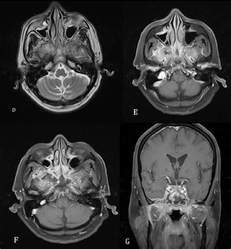 Figure 2 From CT And MRI Findings In Skull Base Osteomyelitis A