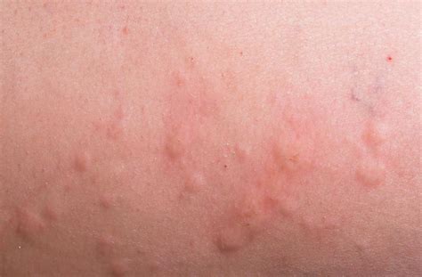 What Are The Causes Of Red Hives With Pictures