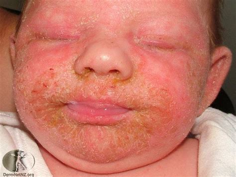 Contact Dermatitis Baby Cheeks Xuan Stitt