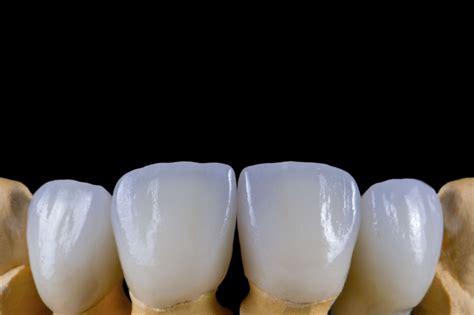 Woodland Hills Dentist Uses Dental Veneers To Improve Smile Beauty