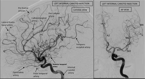 Internal Carotid Artery Injection Depicting Its Branches Download
