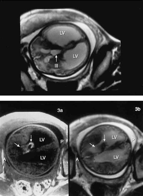 Figure 3 From Fetal Hydrocephalus Secondary To Intraventricular