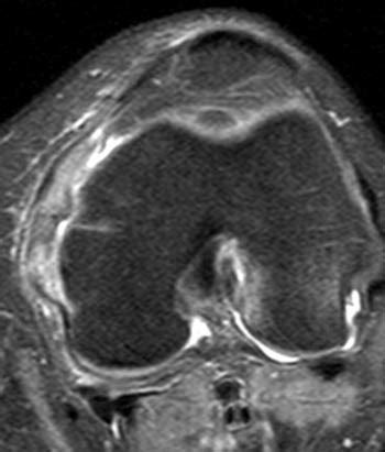 A torn acl mri can help you quickly diagnosis your injury so you can take the next a torn acl commonly occurs during physical activity that involves a sudden change of direction or a quick stop. Partial ACL Tear - Radsource
