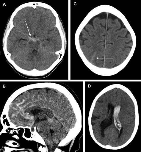 Subarachnoid Hemorrhage Of Unknown Cause Radiology Key
