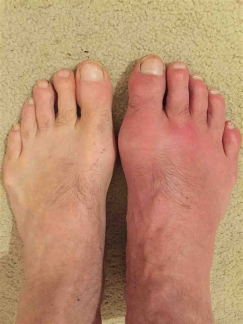 What Are The Symptoms Of Gout In The Foot