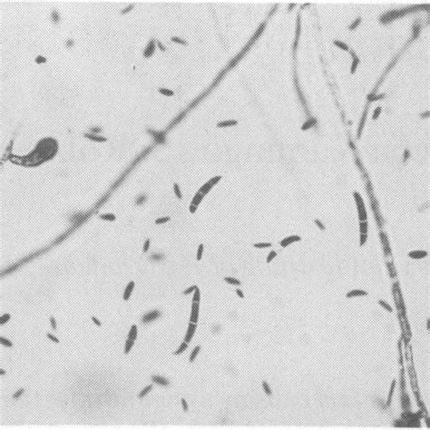 Culture Showing Hyaline Septate Hyphae Sickle Shaped Macroconidia And