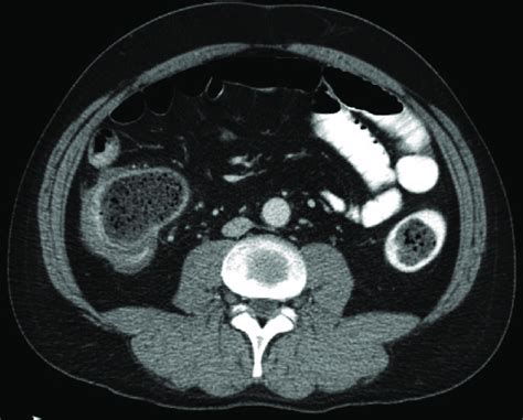 Axial Slice Of An Abdominal Ct Scan Performed With Iv Oral And Rectal