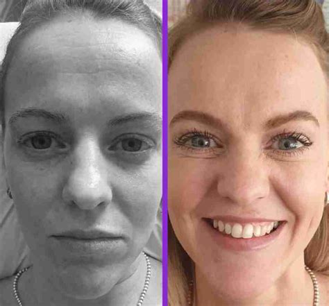 Facial Peels Manchester Chemical Face Peels For Brighter Radiant Skin