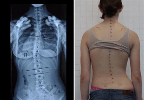 Case Study Idiopathic Scoliosis In Young Female Gymnast Scolicare