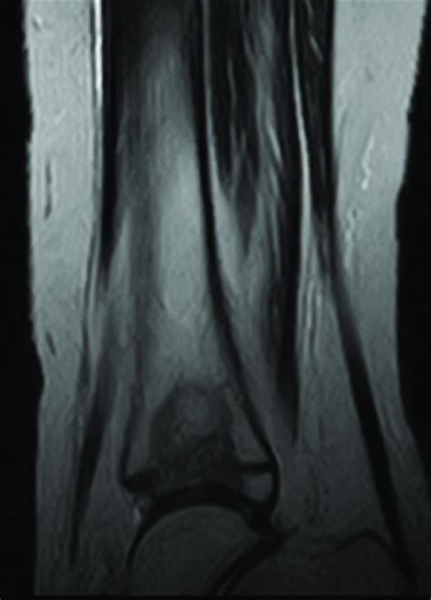 T2 Weighted Images Of The Distal Tibial Metaphysis Post Treatment