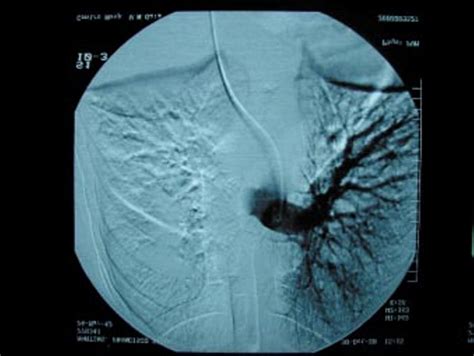 Angiografia Pulmonar Oclusão Trombótica Da Artéria Pulmonar Dtª