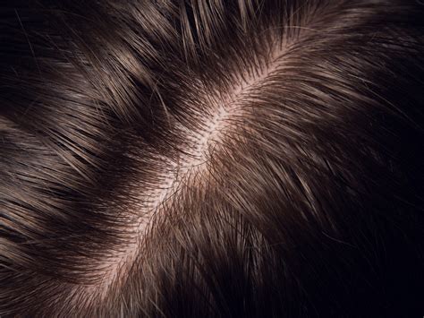 Scalp Ringworm Causes Symptoms And Treatment