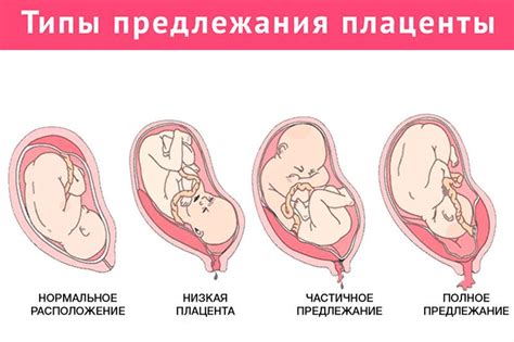 Placenta praevia is where the placenta is fully or partially attached to the lower uterine segment. Предлежание плаценты при беременности: причины, симптомы ...