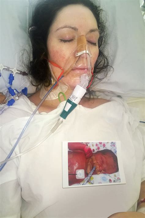 Mum With Subchorionic Hematoma Goes Into Induced Coma After Losing