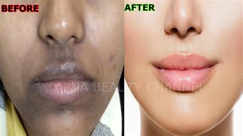 Hyperpigmentation Around The Mouth Causes And Treatments Justinboey