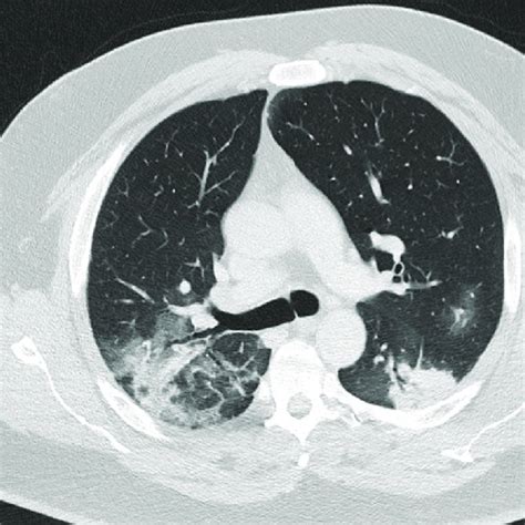 Chest Computed Tomography On Admission Showing Bilateral Infiltrates