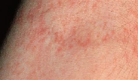 Scarlet Fever Rash Image Pictures Photos