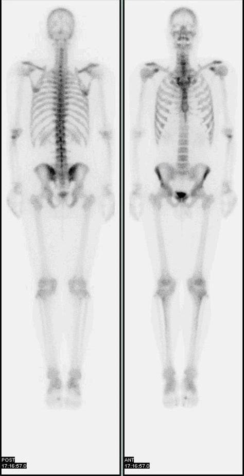 Bone Scintigraphy Wikipedia Scan Bones Nuclear Medicine