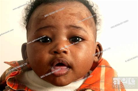 The Face Of An Infant Of 3 Months Suffering From Seborrheic Dermatitis