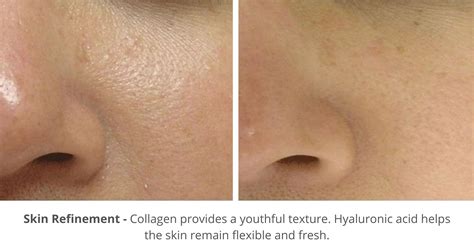 Hydrafacial Before and After Photos - London Premier Laser