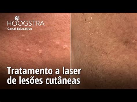 Tratamento a laser de lesões cutâneas 23210 YouTube