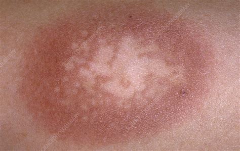 Lesion On Skin In Fixed Drug Eruption Stock Image C0459562