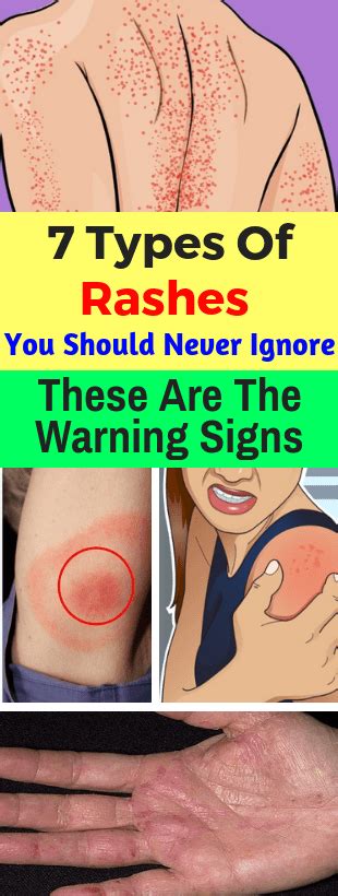 8 Common Types Of Rashes Types Of Rashes Common Skin Rashes Types Of