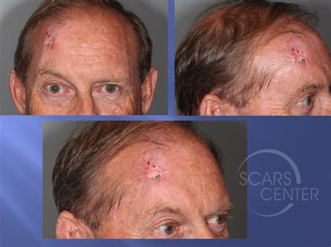 Staging Of Recurrent Extensive Basal Cell Carcinoma Of The Forehead