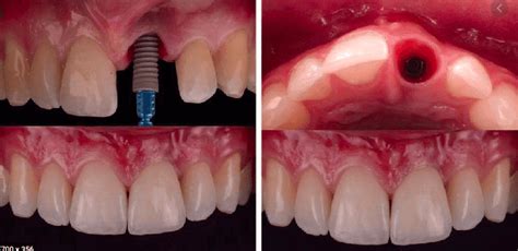 Missing Teeth No More Dental Implants Is The Best Option