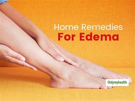 Home Remedies For Edema Try These Remedial Options To Relieve