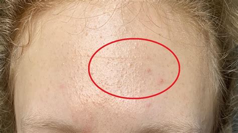 How To Treat Fungal Acne Tiny Bumps On Forehead Self